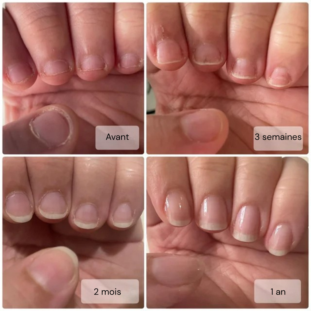 MediGel Nail Strip